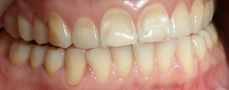 sbiancamento dentale - erosione dentale