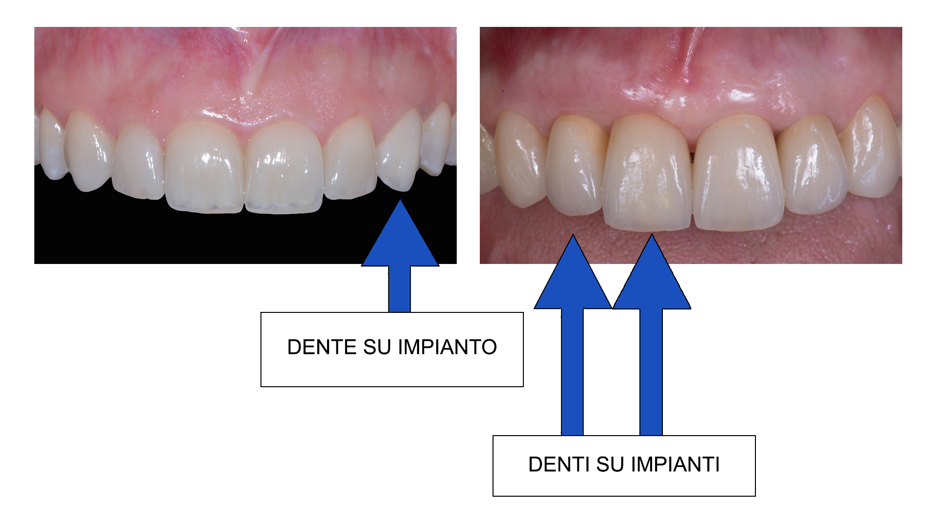 Implantologia e Casi Complessi Cuneo Mondovì Saluzzo