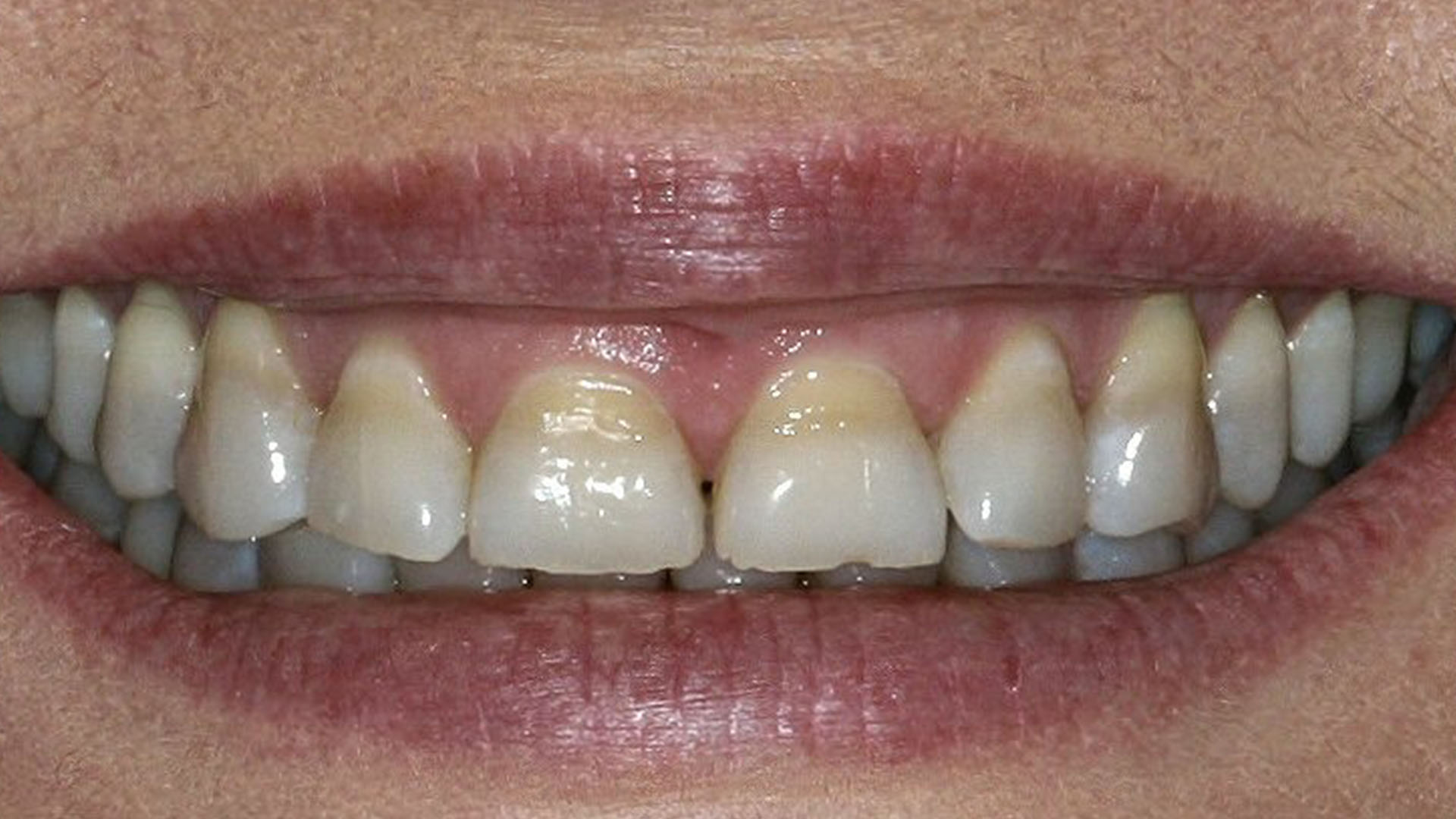 sbiancamento dentale - discromia da tetracicline